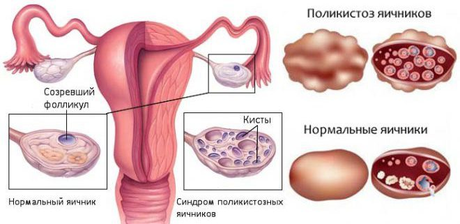 Поликистоз яичников: причины, симптомы, лечение | Балтмед